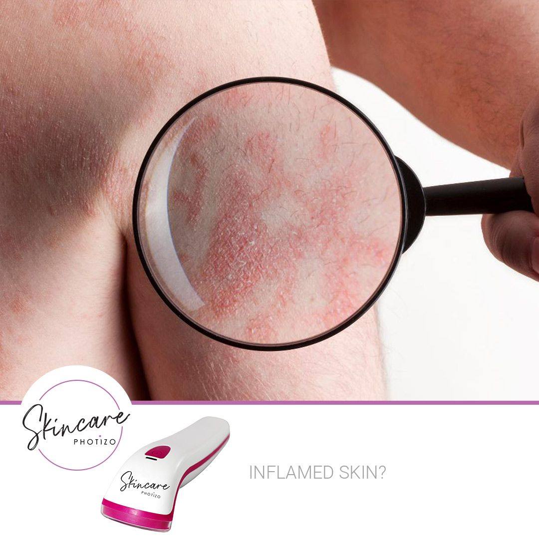 SKINCARE- Photizo Therapy For Treatment Of Wounds/Scars