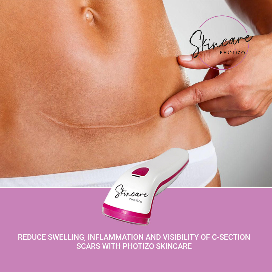 SKINCARE- Photizo Therapy For Treatment Of Wounds/Scars
